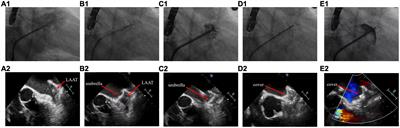 Percutaneous left atrial appendage closure using the LAmbre device in patients with atrial fibrillation and left atrial appendage thrombus